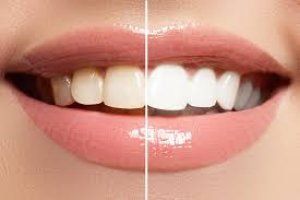 dientes-mas-blancos